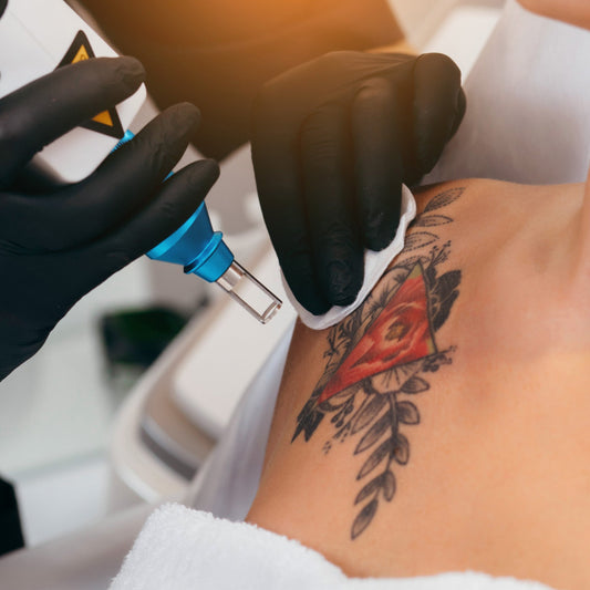 Technician in black gloves performing laser removal on a vibrant red and black geometric floral shoulder tattoo.
