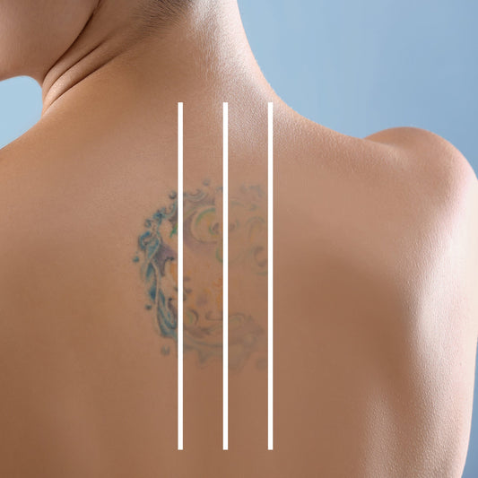 Faded colorful back tattoo intersected by three white lines illustrating the progressive stages of tattoo lightening and removal.